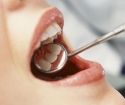 How to get rid of dental stone