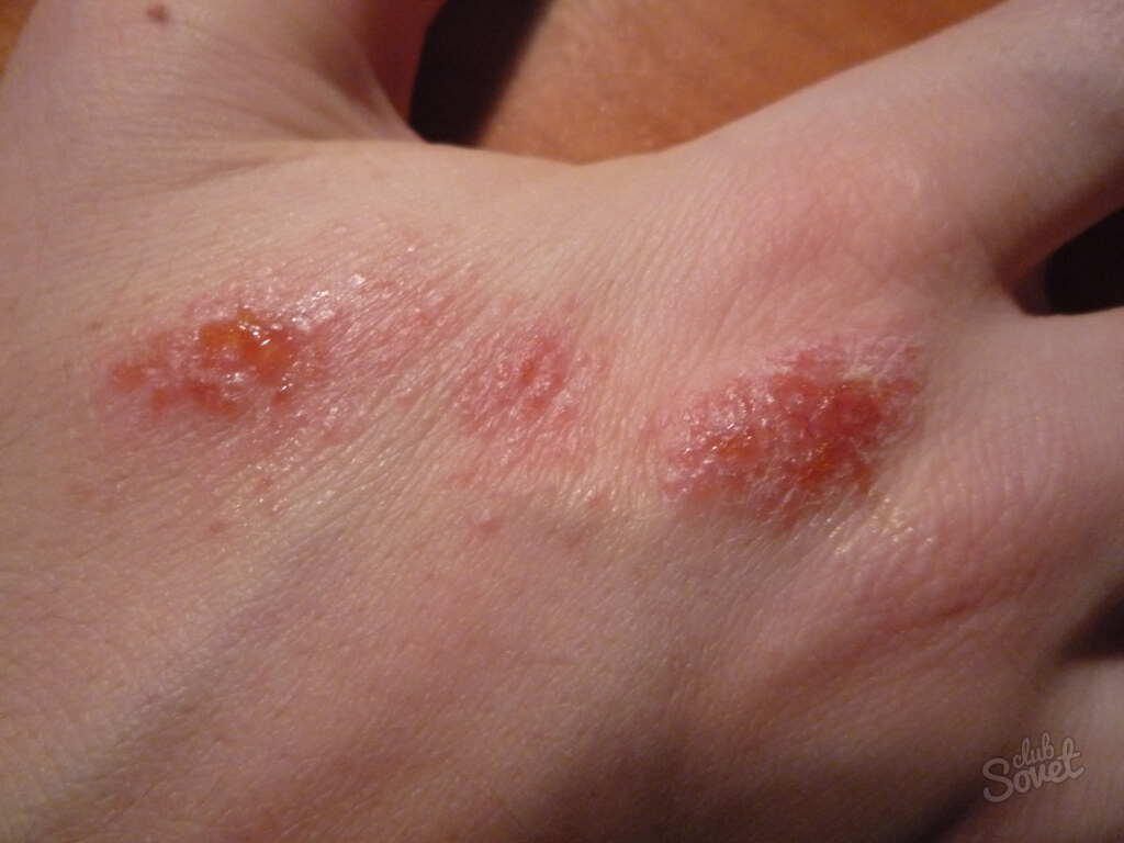 Mochovanie dermatitídy Ako liečiť
