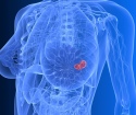 Wie man Brustkrebs bestimmt