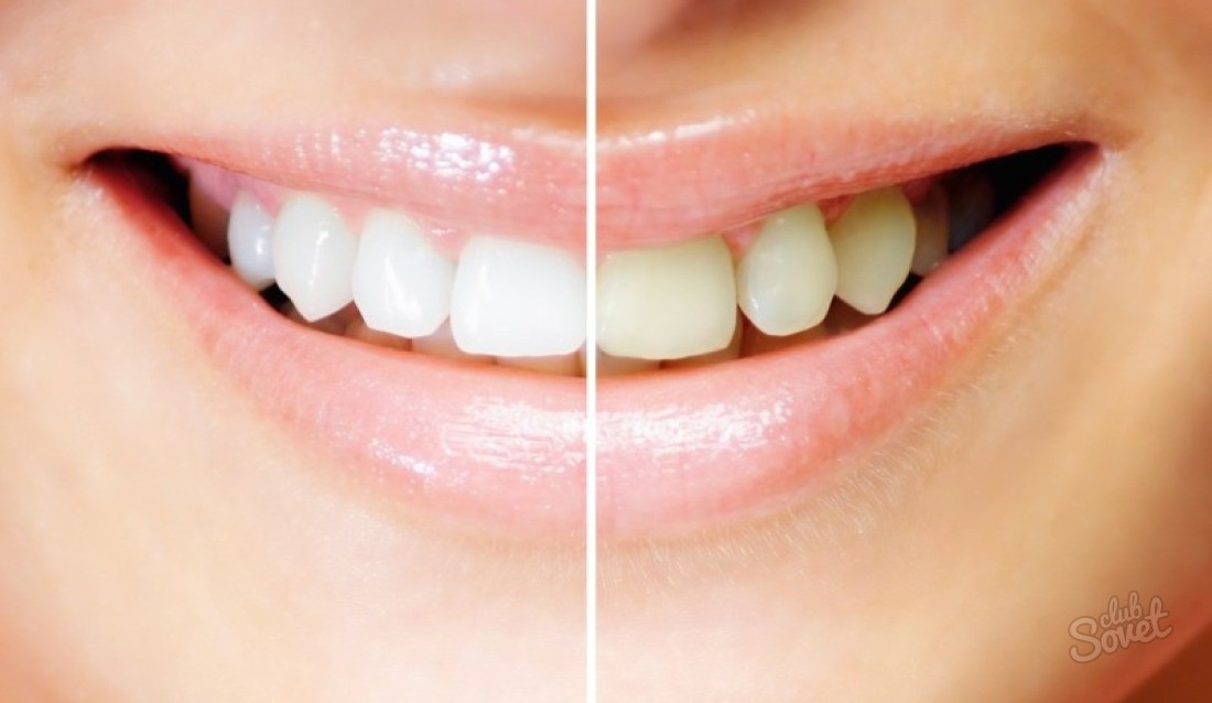 Gel sbiancante per i denti - vero o mito