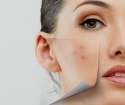 Inner acne, how to get rid of