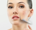 Kako brzo ukloniti acne s lica