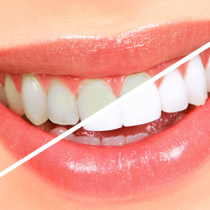 چگونه دندان های پراکسید هیدروژن را سفید کنید
