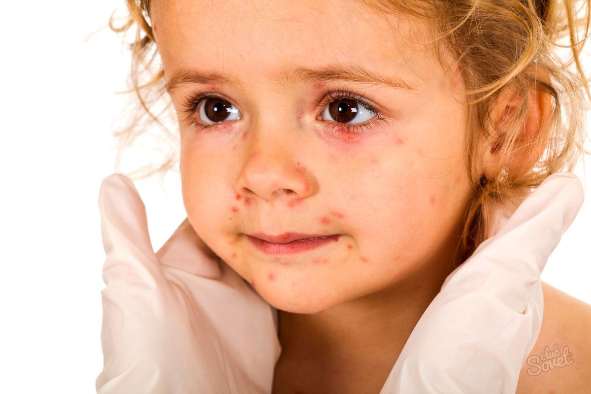 Алергично-обрив в дете