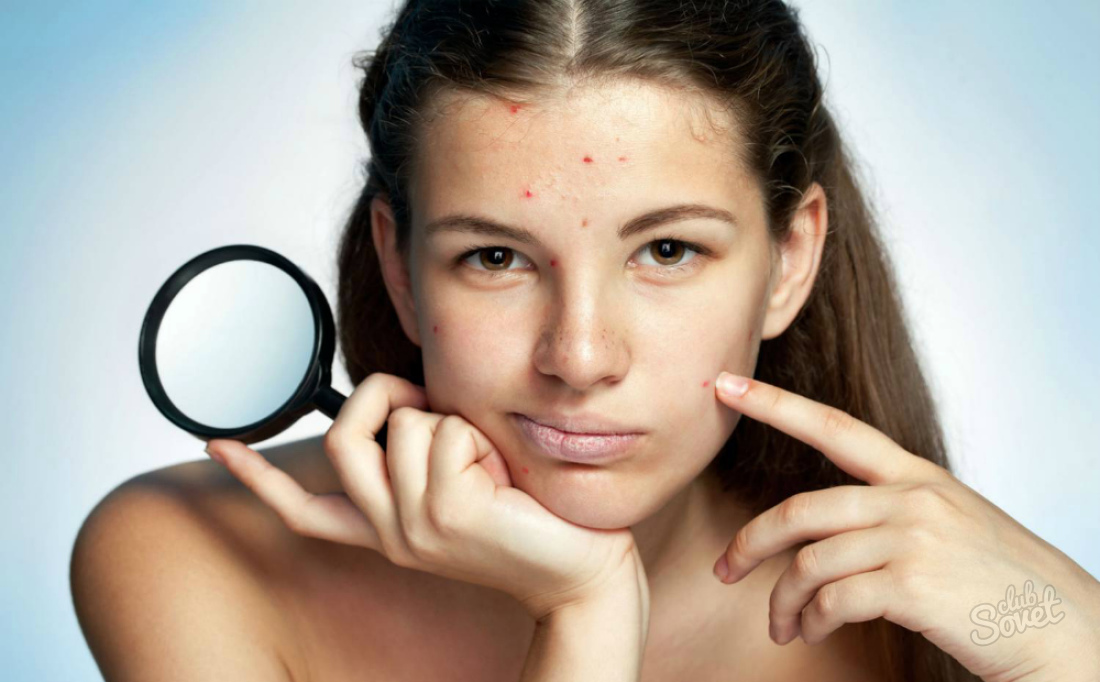 Come sbarazzarsi di acne rapidamente
