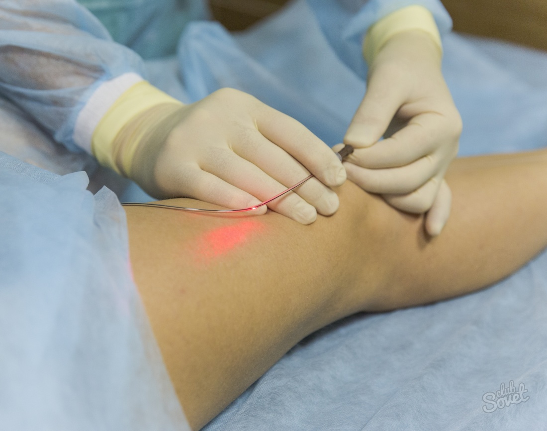 Laser coagulation varicose veins