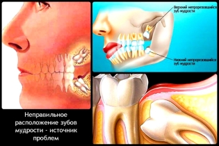 Do you need to remove wisdom teeth, if they do not hurt