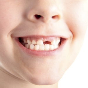 Stock Foto Spada ząb w dziecku, co robić