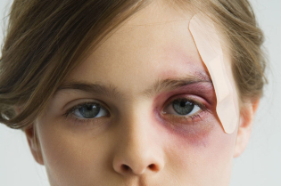 How to quickly reduce bruises under the eye
