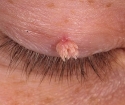 Warts in front of how to get rid of