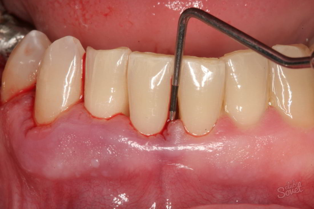Hur man behandlar periodontal sjukdom