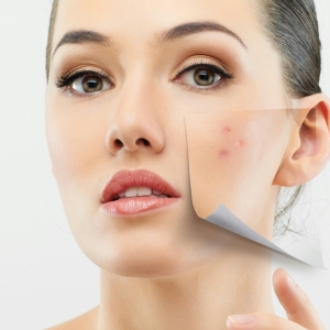 Foto Como remover rapidamente a acne do rosto