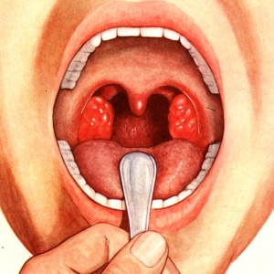 Снимка какво е tonsillit