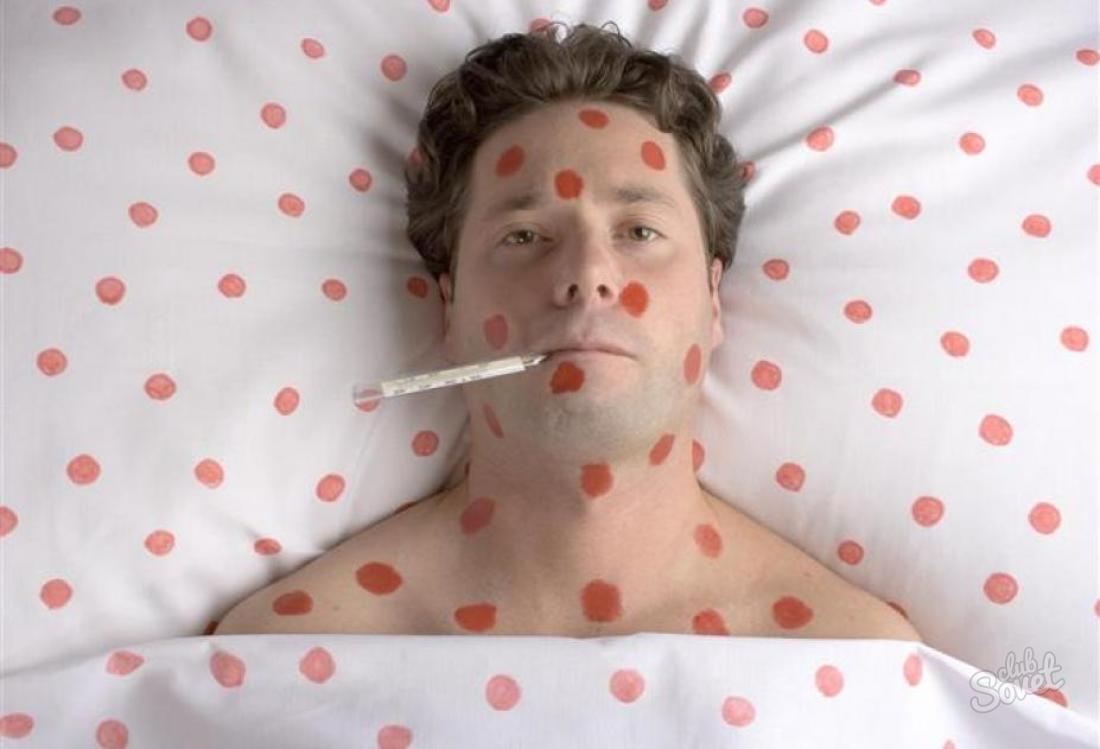 How to treat chickenpox in adults