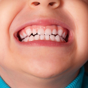 كم عدد أسنان الألبان في الأطفال