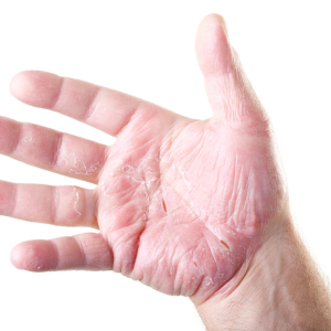 Comment guérir ancase sur les mains