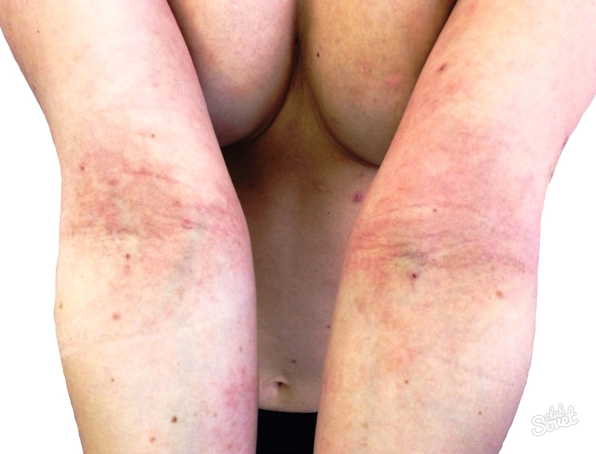 كيفية علاج التهاب الجلد التأتبي
