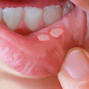 How to treat ulcers in the mouth