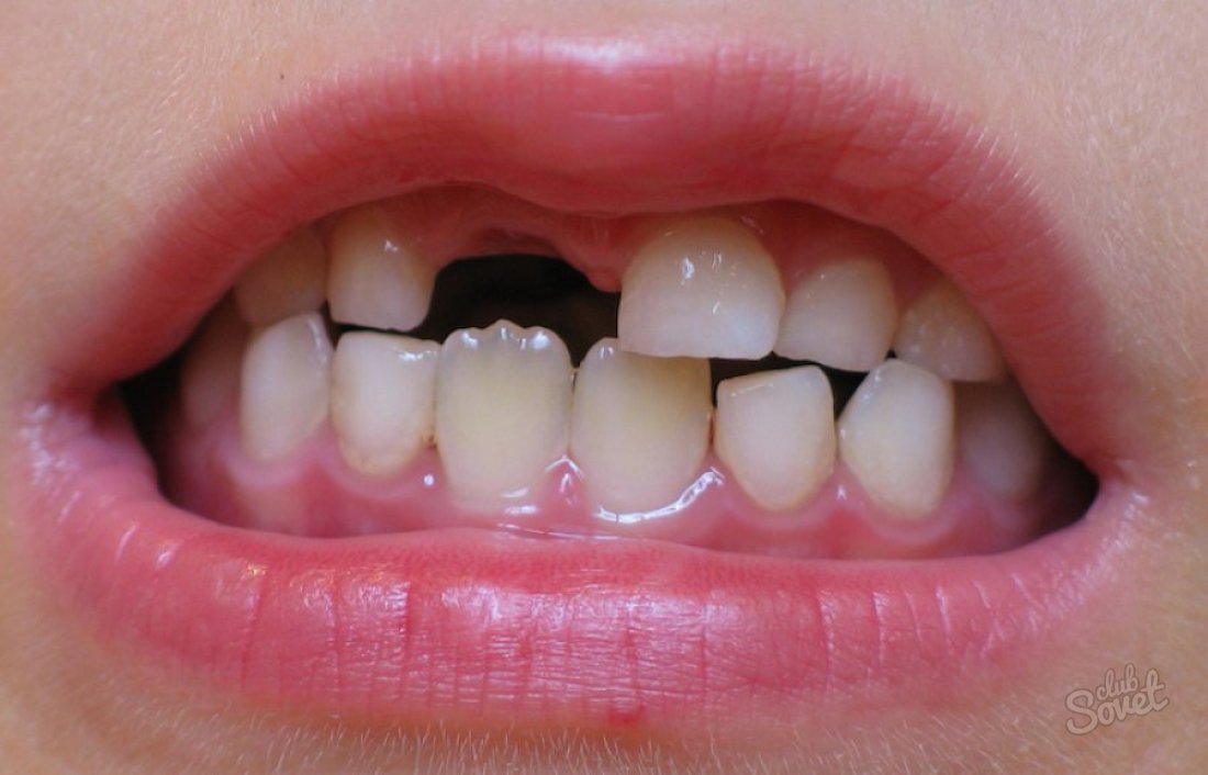 К чему снится – зубы выпадают с кровью?