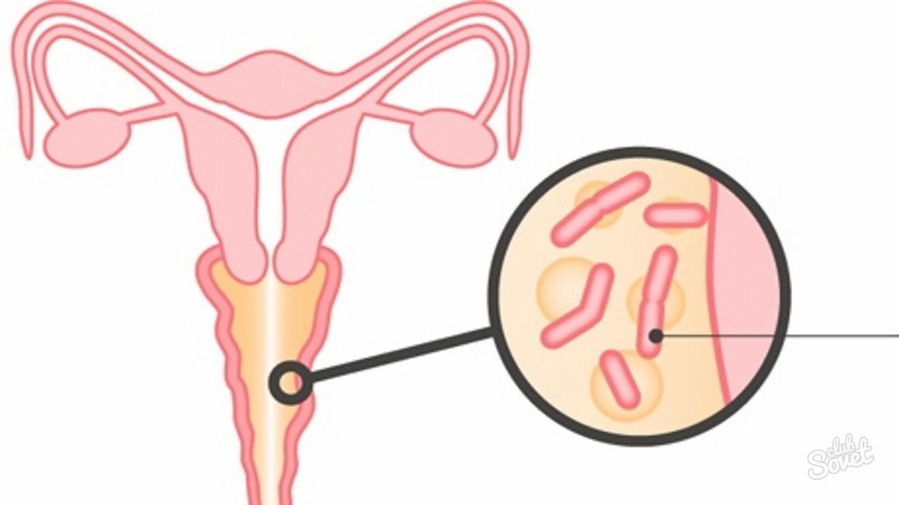 Бактериальный вагиноз картинки