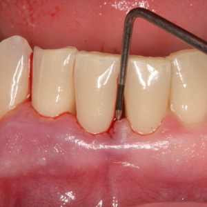 Photo Ako liečiť periodontalosis