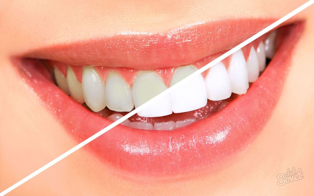 Как отбелить дома зубы