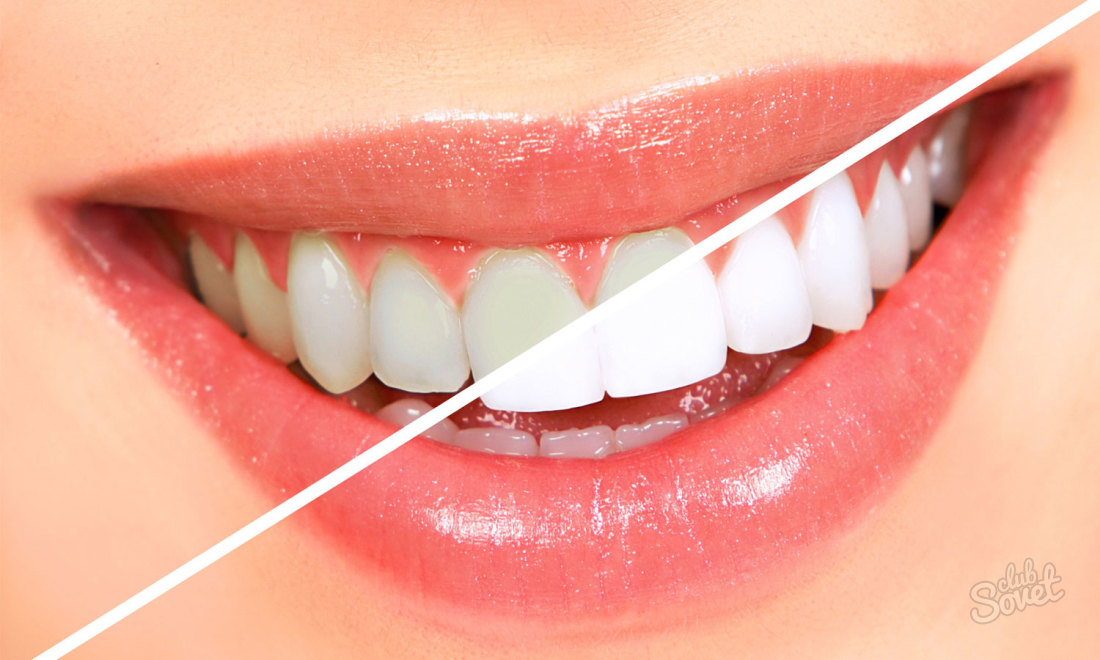 როგორ უნდა whiten კბილები hydrogen პეროქსიდი