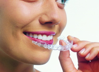 Boca guarda para alinhamento dos dentes, como usar