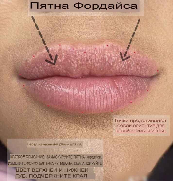 как убрать пятная на губах - белые точки фордайса