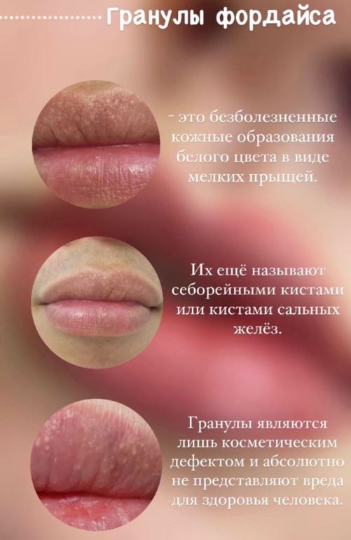 кожные заболевания пятна на губах белые точки