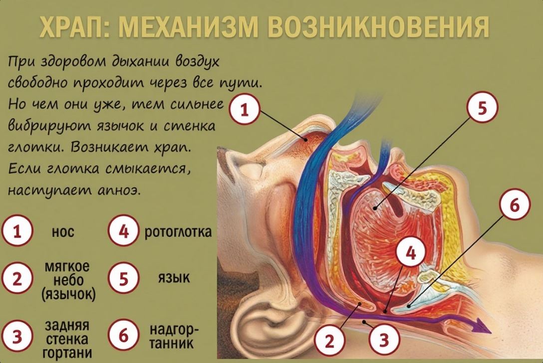 механизм возникновения храпа